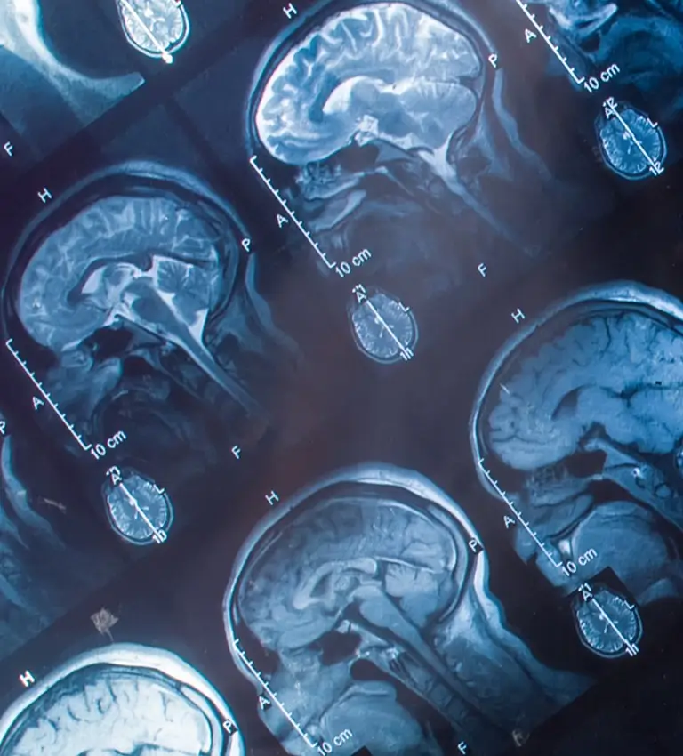 mri brain scans