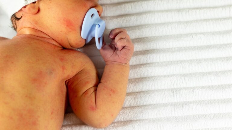 newborn with jaundice