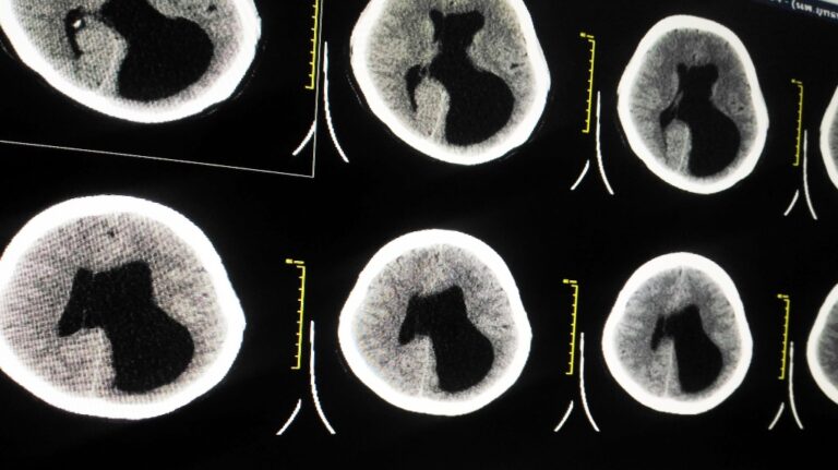 CT-Brain a human showing Left unilateral ventriculomegaly