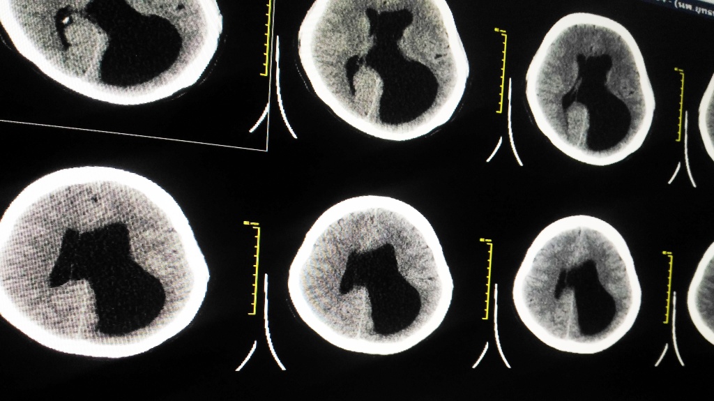 CT-Brain a human showing Left unilateral ventriculomegaly