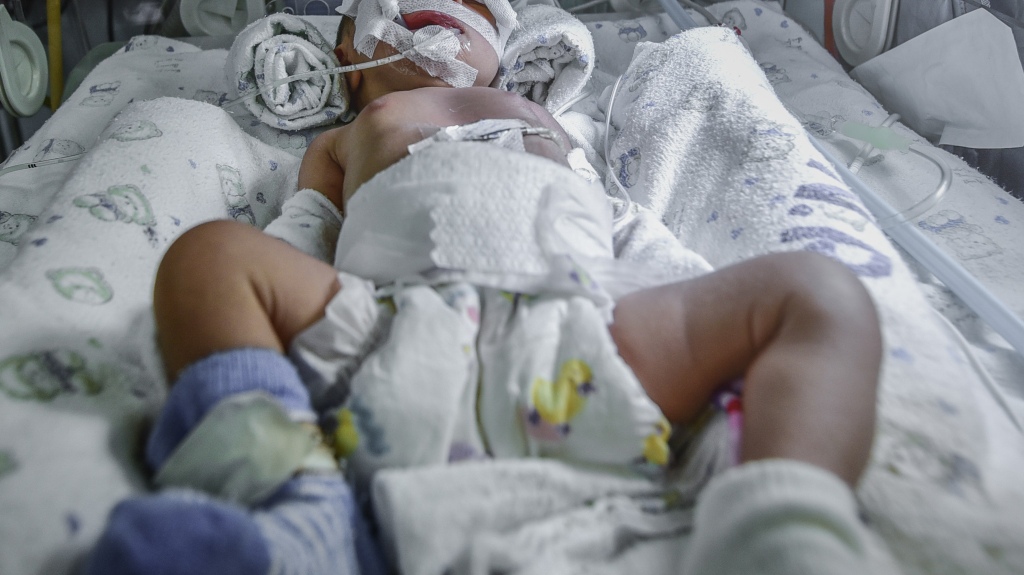 Sick newborn baby on breathing machine