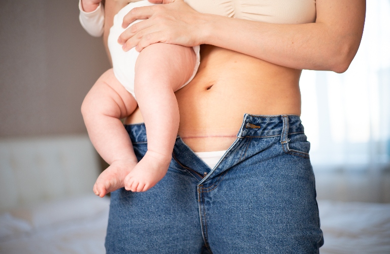 Mom's abdomen after cesarean section